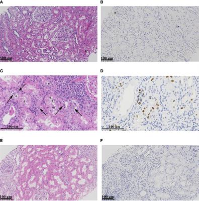 Endoplasmic Reticulum Stress Mediates Renal Tubular Vacuolation in BK Polyomavirus-Associated Nephropathy